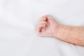 赤ちゃんにアレルギー反応が出たらどうする？原因や受診する目安も紹介